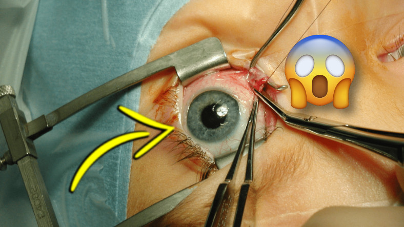 Başka Organları Normalleştirdik, Pekala Ya ‘Göz Nakli’ Mümkün mü?